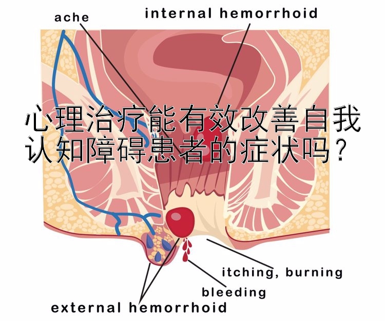 心理治疗能有效改善自我认知障碍患者的症状吗？